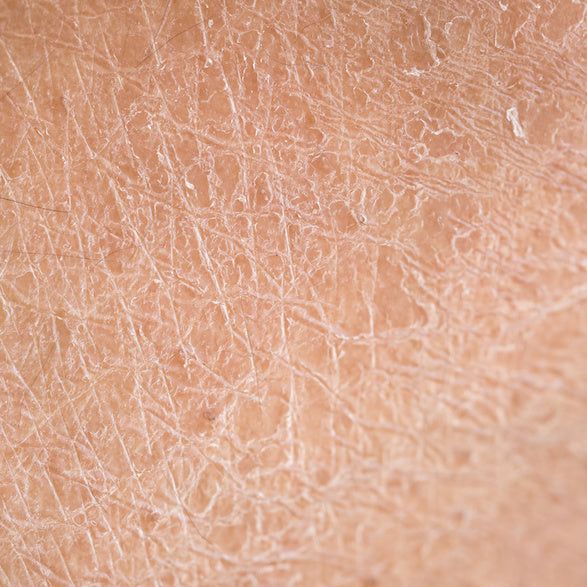 Illustration showing a skin cross-section and moisture at the surface